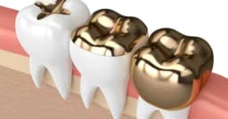 সোনার দাঁত লাগানো কী ইসলামে বৈধ যা বললেন আল-আজহার হাউস অব ফতোয়া